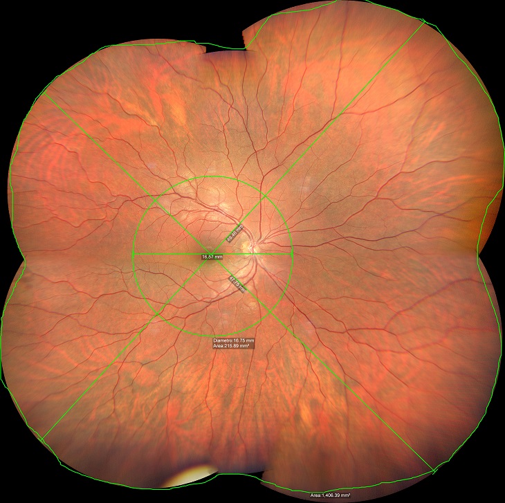 Grande imaging con Clarus 500 Zeiss